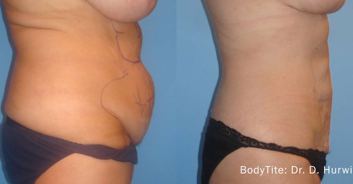 DH BodyTite 1a Abdomen 18Wk LR