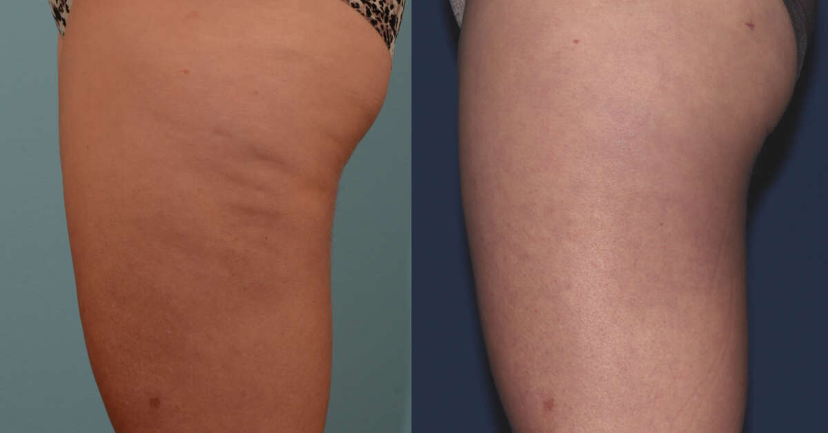 MP BodyTite 1a SideThigh Before6WeeksAfter