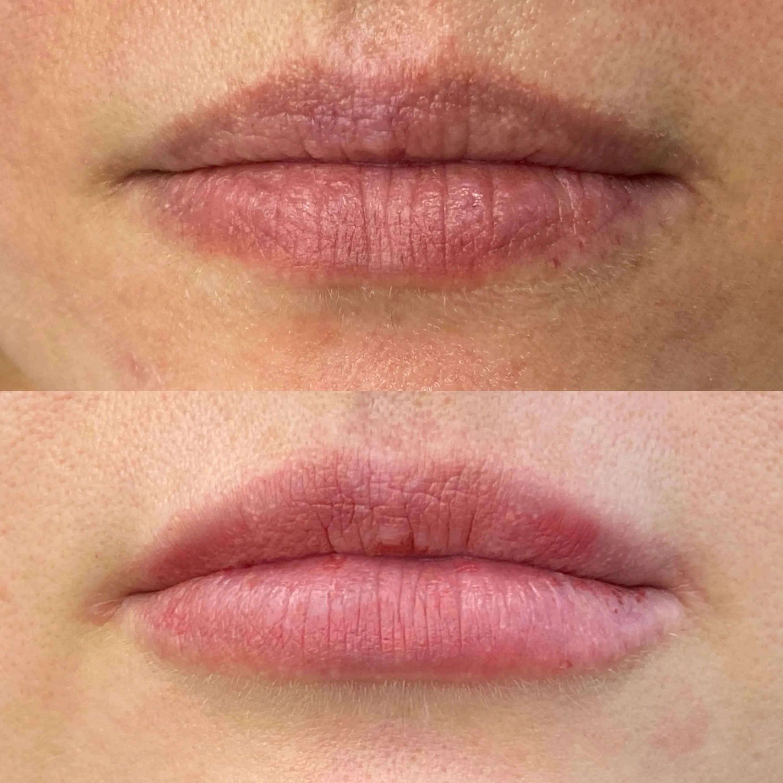 augmentare buze acid hialuronic 3