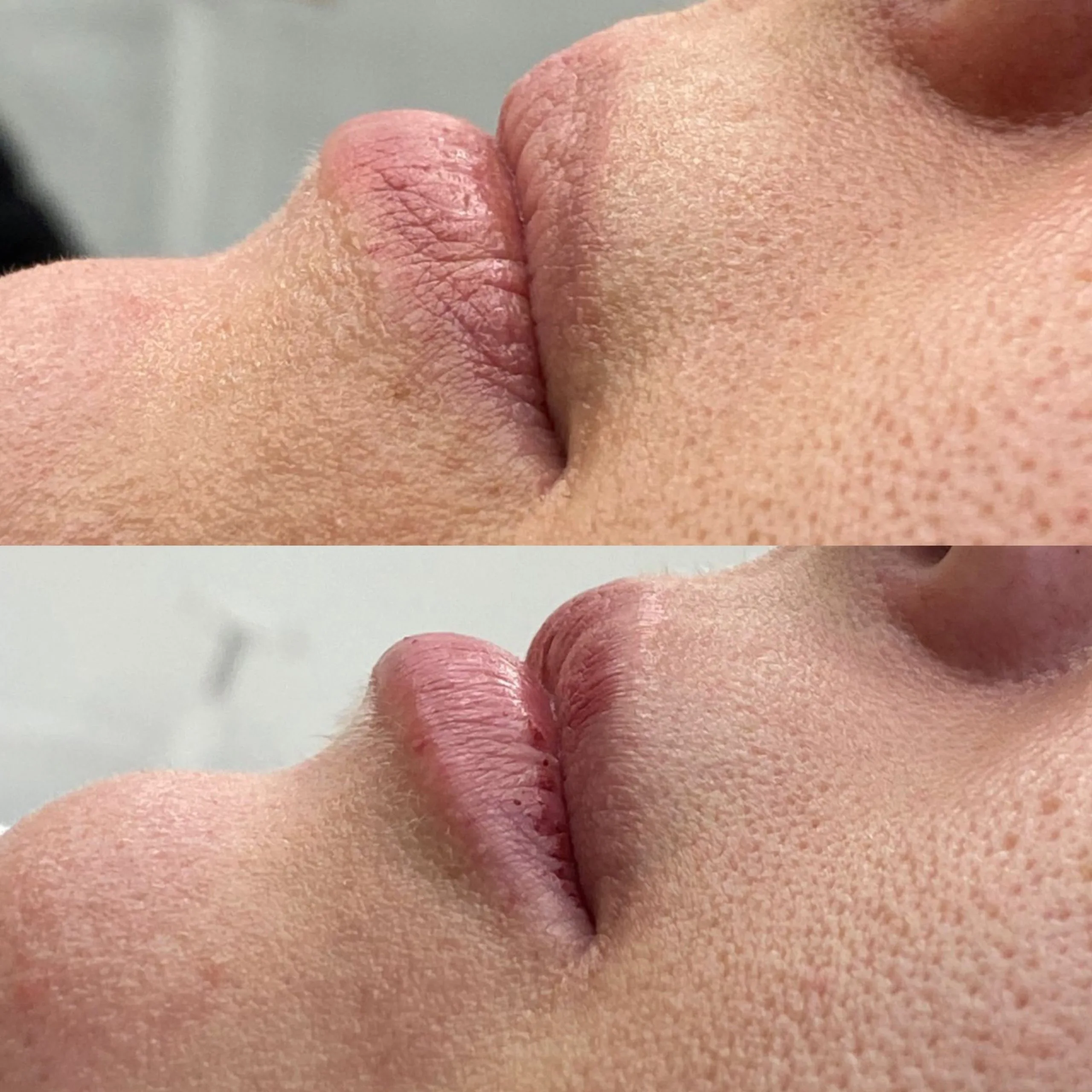 augmentare buze acid hialuronic 4