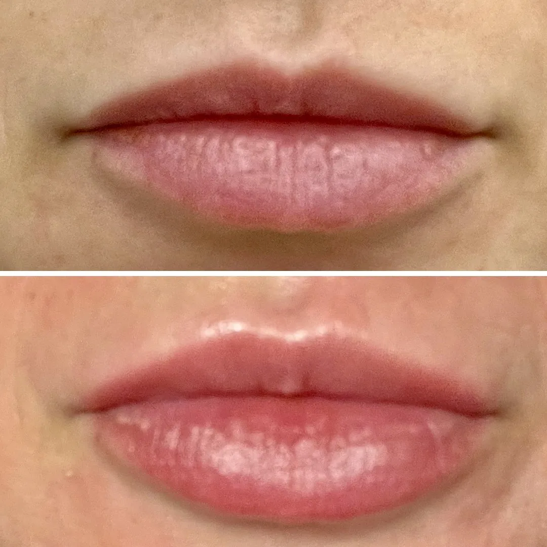 augmentare buze acid hialuronic 5