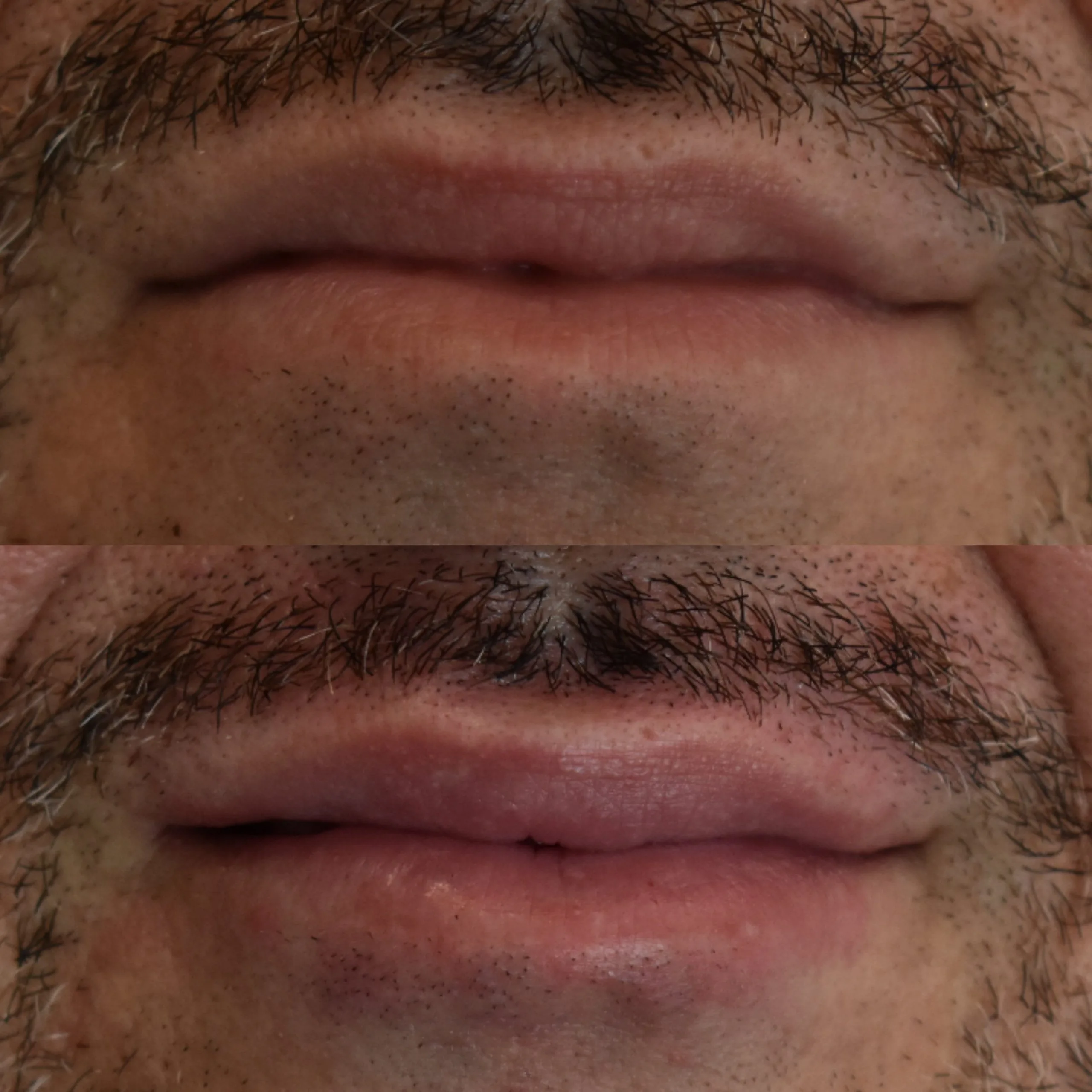 marire buze acid hialuronic brasov skin laser clinic