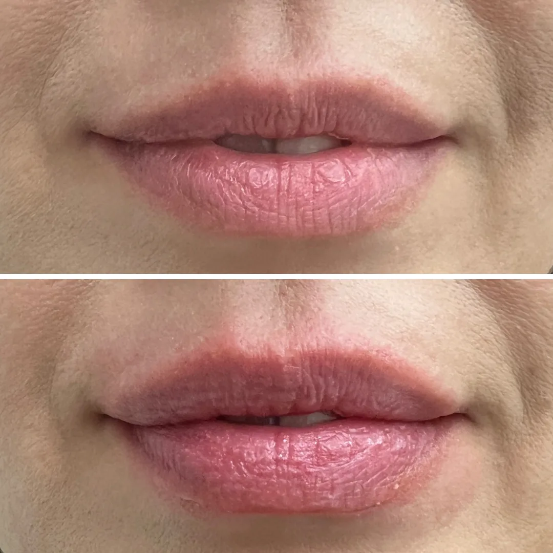 marire buze acid hialuronic brasov