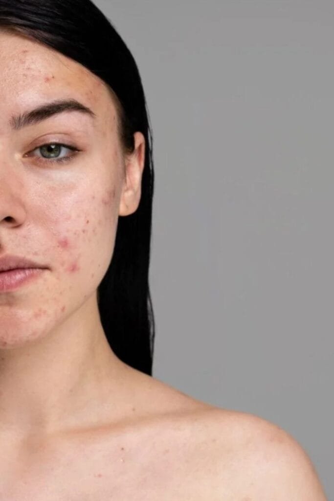 tratament laser brasov skin laser clinic