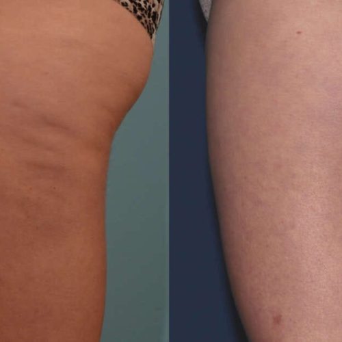 MP-BodyTite-1a-SideThigh-Before6WeeksAfter-1200x628