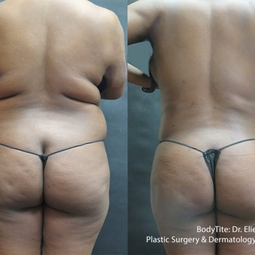 RFAL-Levine-BodyTite-1