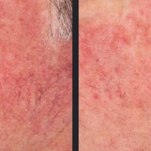 tratament cuperoza laser skin laser clinic brasov