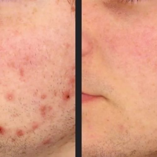 tratament laser acnee inflamatorie skin laser clinic brasov