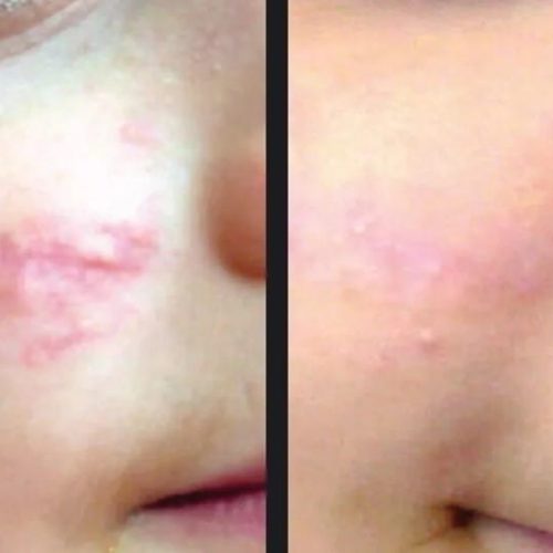 tratament laser acnee skin laser clinic brasov