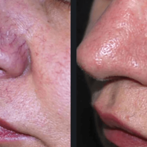 tratament laser cuperoza brasov skin laser clinic