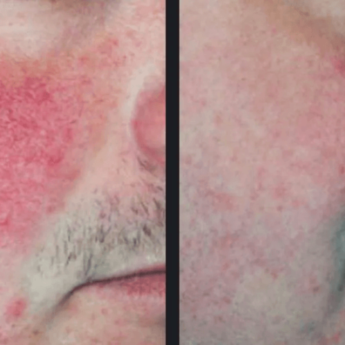 tratament laser leziuni vasculare brasov skin laser clinic