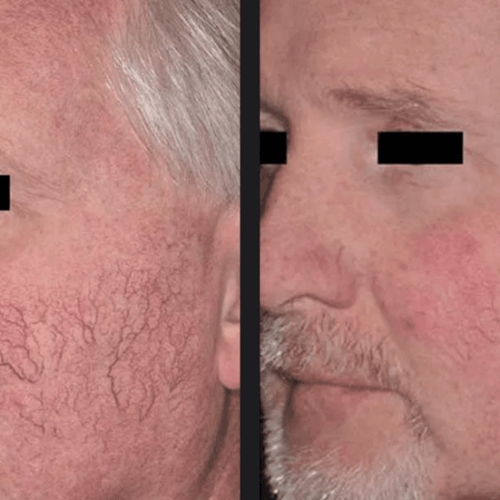 tratament laser rozacee brasov skin laser clinic